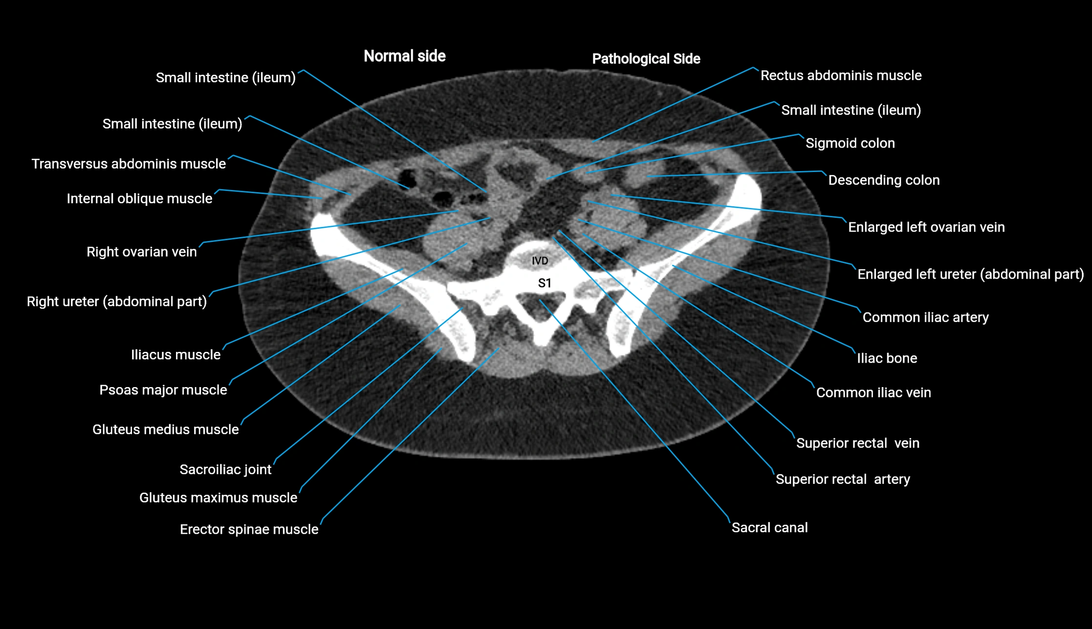 CT KUB axial cross sectional anatomy  radiology image -img-00201-00112.webp